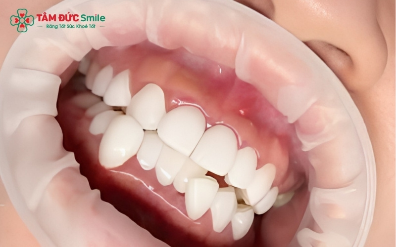 Răng sứ pha lê là giải pháp hoàn hảo để che đi các khuyết điểm về màu sắc và hình thể, giúp tái tạo nụ cười rạng rỡ và đều đặn.