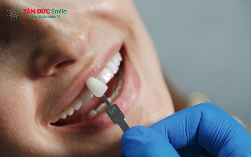 Với khả năng chịu lực vượt trội và không gây đen viền nướu, răng sứ Roland mang lại sự an tâm tuyệt đối về cả chức năng ăn nhai lẫn thẩm mỹ