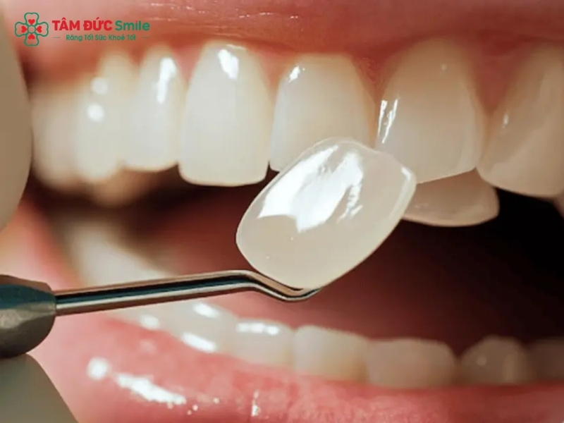 Răng sứ Roland là gì? Răng sứ Roland có tốt không?