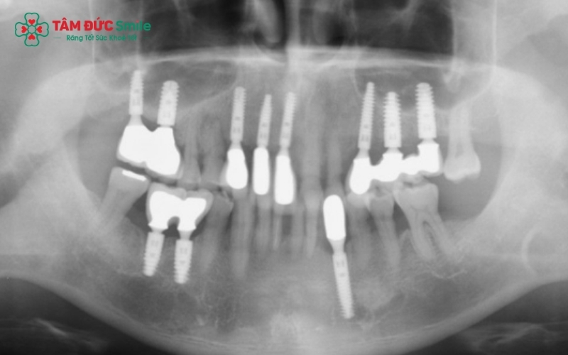 Người bọc răng sứ Titan vẫn có thể chụp MRI, tuy nhiên cần thông báo trước cho bác sĩ chẩn đoán hình ảnh về tình trạng răng miệng của mình.