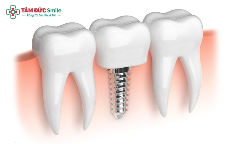 Quá trình tháo răng sứ Titan (nếu cần thiết) được thực hiện bằng kỹ thuật hiện đại, đảm bảo nhẹ nhàng và không gây đau đớn cho người bệnh.