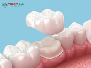 Răng sứ Titan có chụp MRI được không?