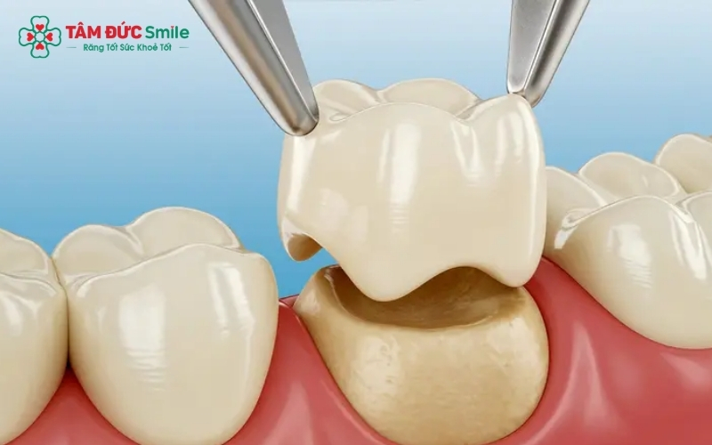 Răng toàn sứ 100% không chứa kim loại là lựa chọn tối ưu, hoàn toàn không gây nhiễu ảnh và an toàn tuyệt đối khi chụp MRI.