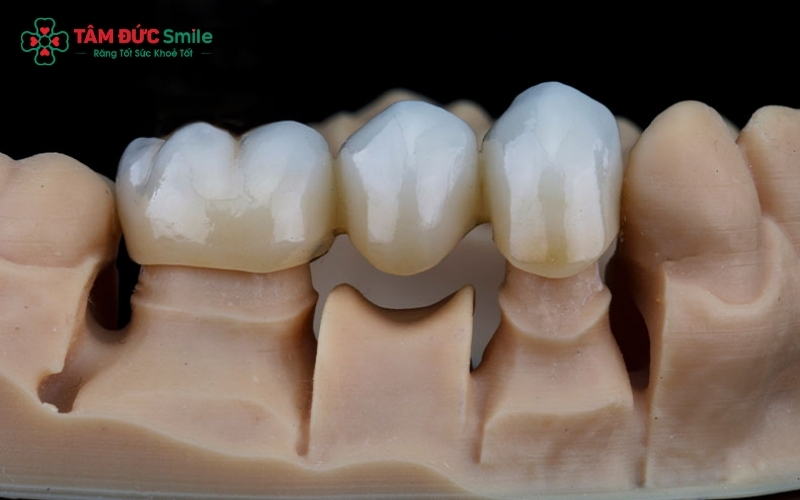 Răng sứ Titan có lớp sườn kim loại bên trong, trong khi răng toàn sứ được cấu tạo hoàn toàn từ khối sứ nguyên chất.