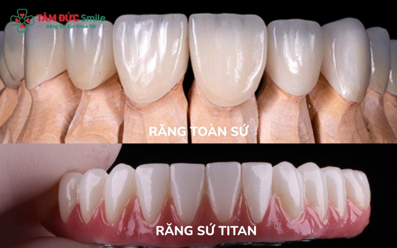 Việc lựa chọn răng sứ Titan hay răng toàn sứ phụ thuộc vào vị trí răng cần phục hình, yêu cầu thẩm mỹ và điều kiện tài chính của khách hàng.