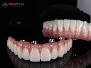 Răng sứ Titan và răng toàn sứ khác nhau gì?