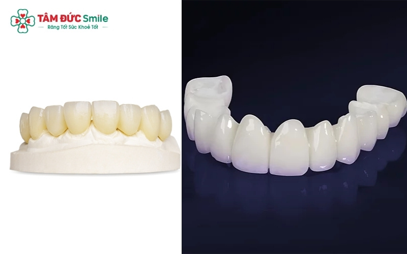 Venus và Zirconia là hai đại diện tiêu biểu trong dòng răng toàn sứ hiện nay.