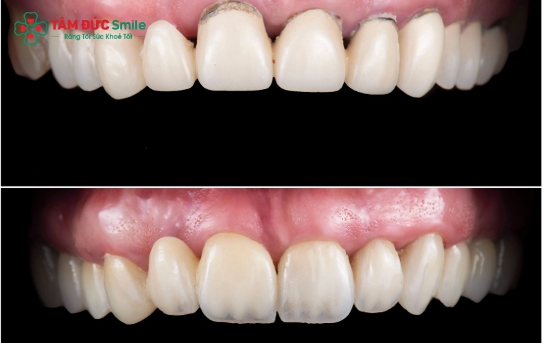 Zirconia có ưu thế về độ bền và độ trong mờ, trong khi Venus là lựa chọn tối ưu về chi phí.