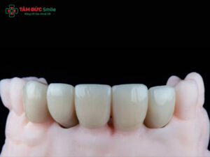 Răng sứ Venus và Zirconia: So sánh chi tiết, nên chọn loại nào?
