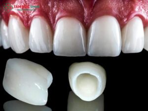 Răng sứ Zirconia Crystal có tốt không? Ai nên bọc răng sứ Zirconia Crystal?