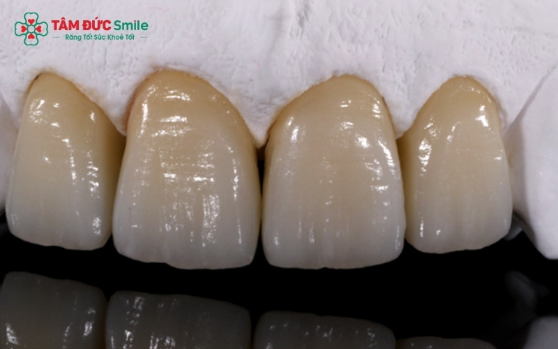 Dòng sứ HT đòi hỏi quy trình chế tác tinh xảo và sự chỉ định chính xác từ bác sĩ để đảm bảo độ bền cũng như hiệu quả thẩm mỹ cao nhất.
