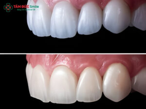 Răng sứ Zirconia HT là gì? Răng sứ Zirconia HT có tốt không?