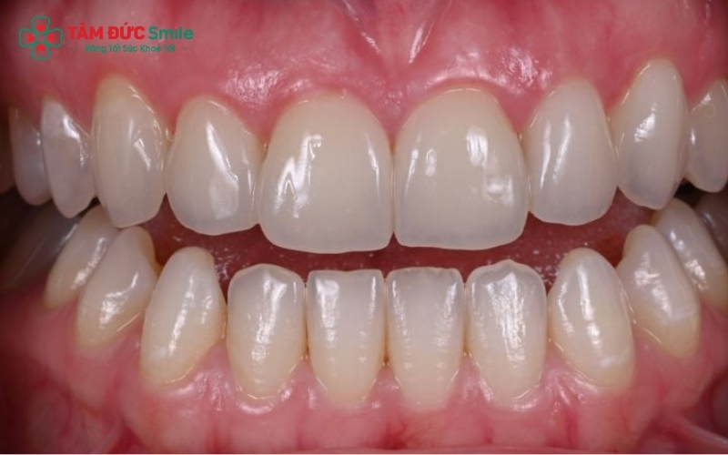 Zirconia HT là giải pháp tối ưu cho những người muốn thay thế răng sứ kim loại cũ hoặc mong muốn phục hình răng cửa bị xỉn màu, mẻ, vỡ.