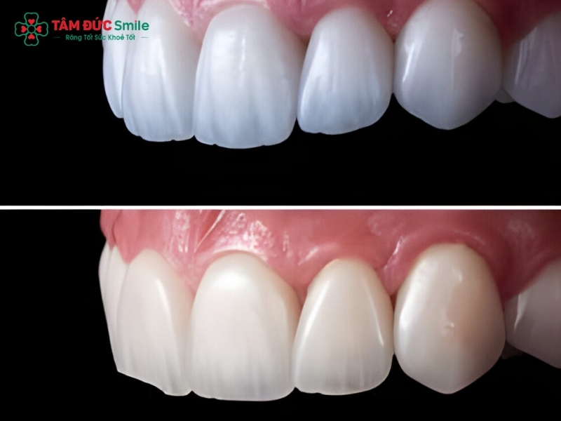 Răng sứ Zirconia HT là gì? Răng sứ Zirconia HT có tốt không?