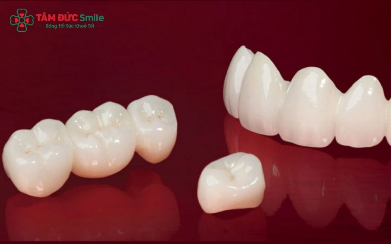 Cấu tạo đặc trưng của răng sứ kim loại với lớp sườn hợp kim chắc chắn bên trong.