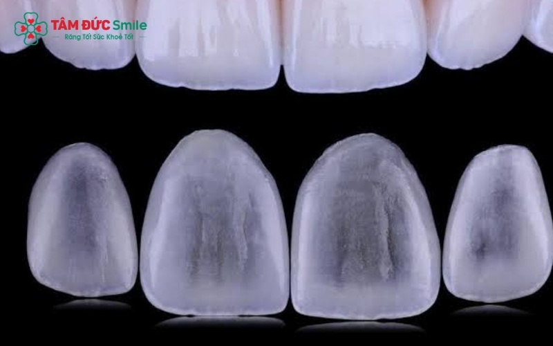 Hiện tượng đen viền nướu là nhược điểm khó tránh khỏi của dòng sứ kim loại thường sau thời gian dài sử dụng.