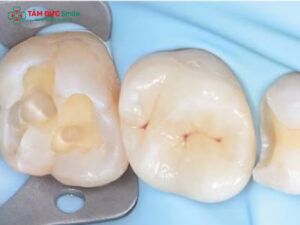 Răng toàn sứ Venus Multi là gì? Ưu và nhược điểm của răng toàn sứ Venus Multi