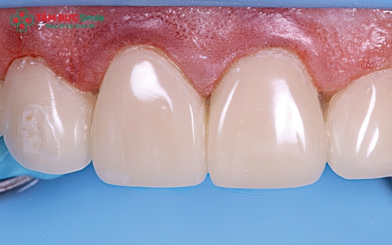 Bọc răng sứ kim loại thường là lựa chọn tiết kiệm và hiệu quả cho các vị trí răng hàm phía trong.
