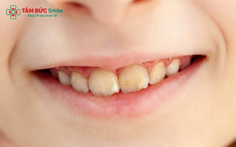  Thói quen ăn uống nhiều đường và vệ sinh răng miệng không kỹ lưỡng là những nguyên nhân phổ biến nhất khiến răng trẻ bị xỉn màu và tích tụ mảng bám.