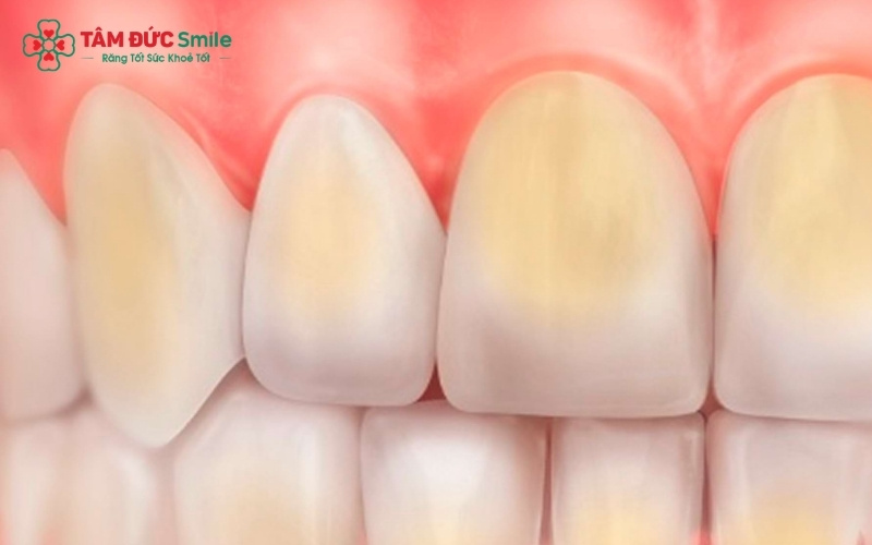  Tuyệt đối không tự ý dùng các loại thuốc tẩy trắng của người lớn cho trẻ; hãy đưa trẻ đến nha khoa để được bác sĩ tư vấn các biện pháp làm sạch an toàn