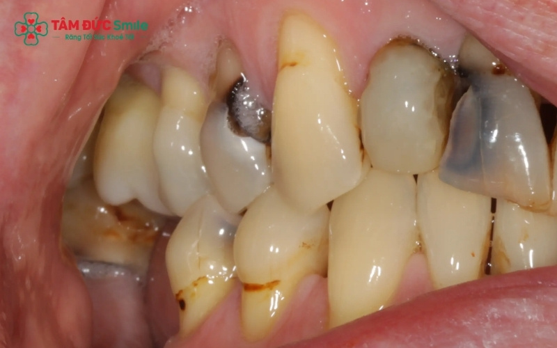 Các chấm đen hoặc lỗ sâu nhỏ trên mặt nhai của răng trong cùng là dấu hiệu cảnh báo sớm bạn cần đến nha khoa thăm khám ngay.