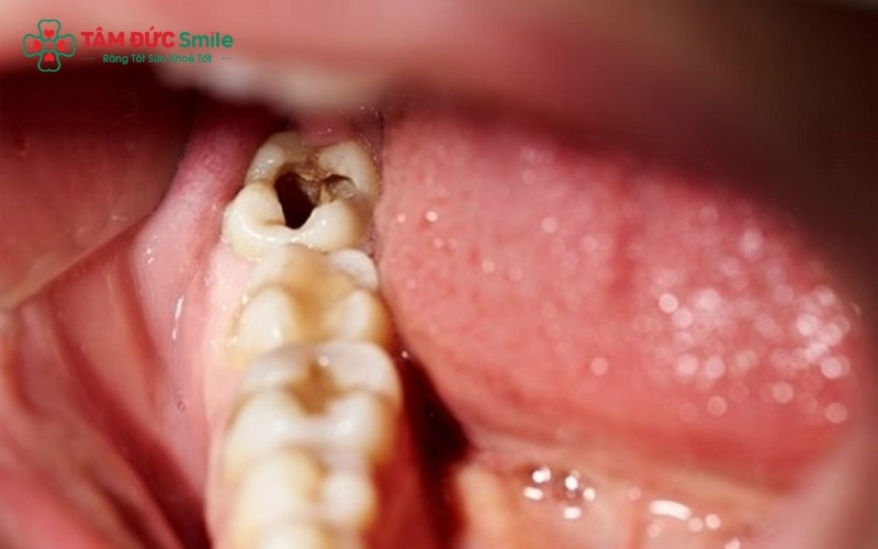 Do nằm ở vị trí khuất sâu và có nhiều rãnh hẹp, răng trong cùng rất khó làm sạch hoàn toàn, tạo điều kiện cho vi khuẩn sâu răng phát triển.