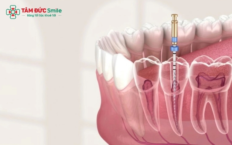 Điều trị tủy là những giải pháp ưu tiên để bảo tồn răng thật khi tình trạng sâu chưa quá nghiêm trọng.