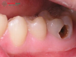 Răng trong cùng hàm dưới bị sâu: Nên trám, chữa tủy hay nhổ?