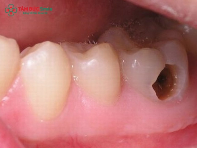Răng trong cùng hàm dưới bị sâu: Nên trám, chữa tủy hay nhổ?