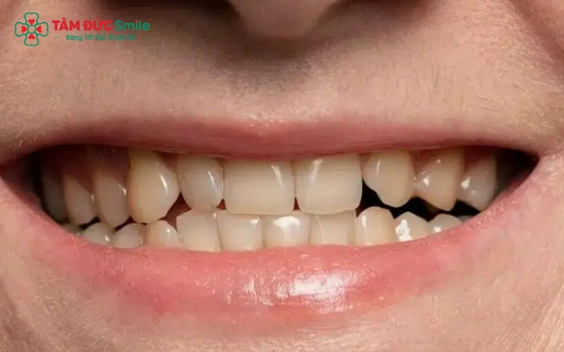 Răng vàng bẩm sinh thường bắt nguồn từ các tác động bên trong cấu trúc ngà răng và men răng, khác hoàn toàn với ố vàng do thực phẩm.