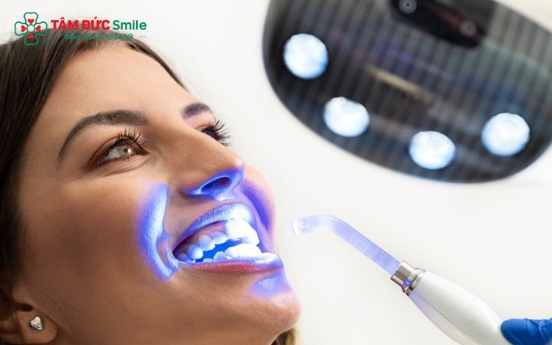 ẩy trắng răng chuyên nghiệp bằng ánh sáng Laser là giải pháp hiệu quả cho các trường hợp răng vàng bẩm sinh ở mức độ nhẹ và trung bình.