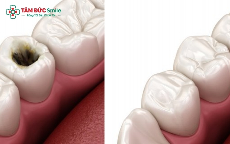 Trám răng bằng vật liệu Composite là phương pháp phổ biến để điều trị sâu chân răng mức độ nhẹ, giúp ngăn chặn vi khuẩn và bảo vệ tủy răng.