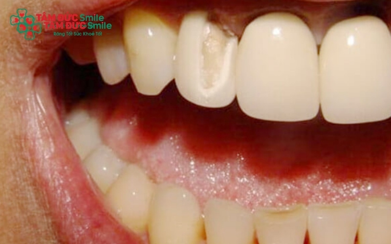 Tụt nướu làm lộ phần chân răng vốn không có lớp men bảo vệ, khiến vi khuẩn dễ dàng tấn công và gây sâu răng tại vị trí này.