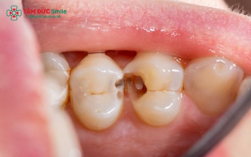 Dấu hiệu điển hình của sâu răng hàm là các lỗ đen, hốc sâu trên mặt nhai gây dắt thức ăn và ê buốt khi ăn uống