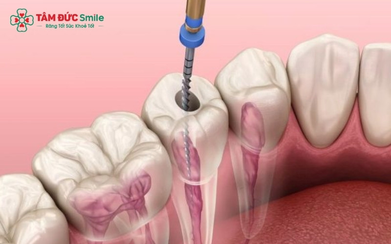Chữa tủy răng (lấy tủy) giúp loại bỏ hoàn toàn phần mô tủy bị viêm nhiễm, hoại tử hoặc vi khuẩn bên trong răng