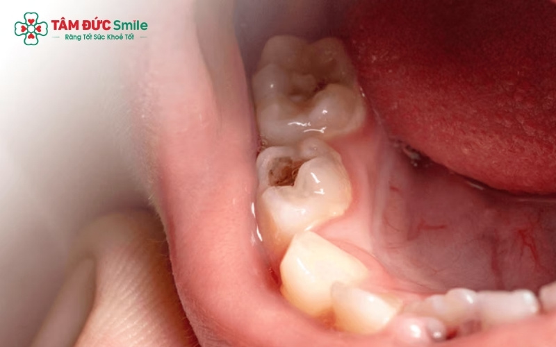 Sâu răng hàm trên nếu không điều trị sớm có thể gây viêm tủy, áp xe và ảnh hưởng trực tiếp đến xoang hàm do vị trí chân răng nằm sát vách xoang