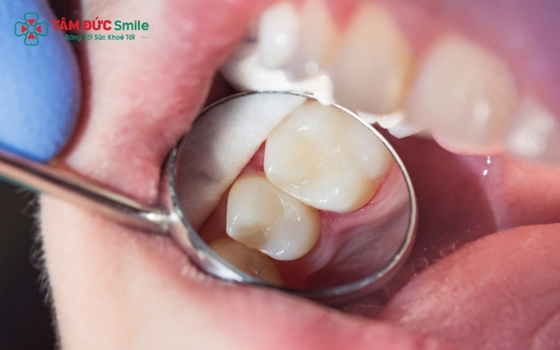 Bác sĩ sẽ ưu tiên bảo tồn răng thật bằng mọi cách; việc nhổ răng sâu hàm trên chỉ được chỉ định khi răng đã vỡ nát hoàn toàn hoặc gây biến chứng nguy hiểm