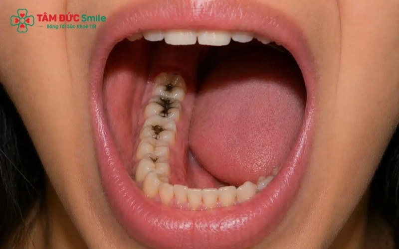 Răng hàm trên trong cùng nằm ở vị trí khuất, khó vệ sinh, khiến vi khuẩn dễ tích tụ gây sâu răng và viêm nhiễm lan rộng mà người bệnh khó tự phát hiện