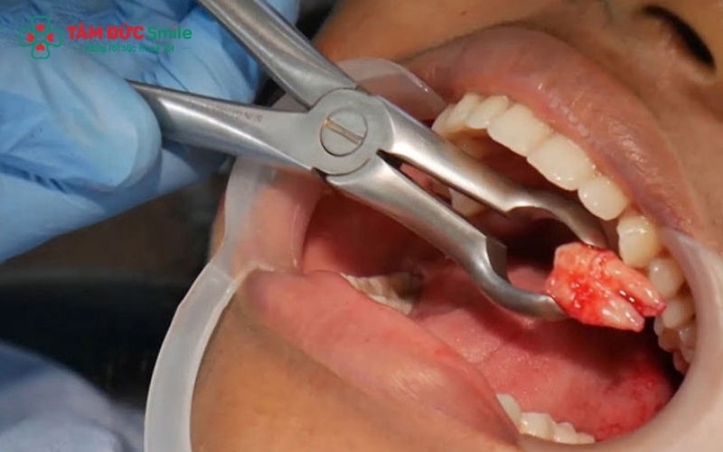 Bác sĩ sẽ xác định chính xác mức độ tổn thương để đưa ra quyết định nên nhổ bỏ hay giữ lại răng hàm bằng phương pháp chữa tủy.