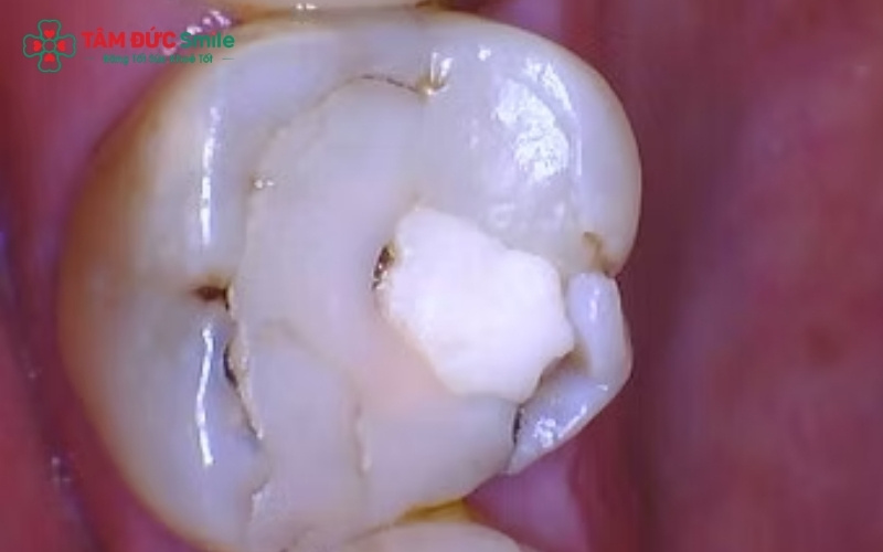 Vệ sinh kỹ lưỡng sau trám răng giúp loại bỏ mảng bám ở các kẽ răng hàm trong cùng, ngăn ngừa sâu răng tái phát sau điều trị.