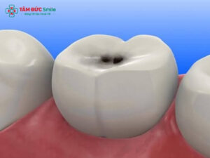 Sâu răng hàm trên trong cùng có nên nhổ không? Cách xử lý an toàn
