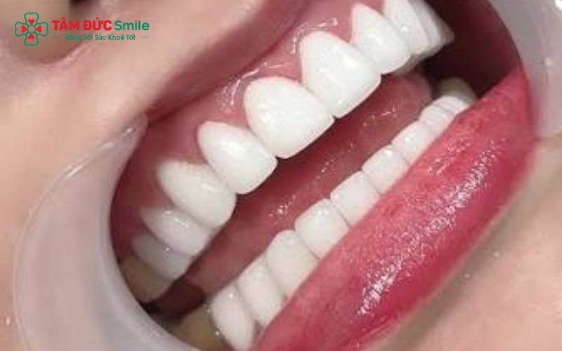 Răng sứ Cercon HT và HT Smile là hai dòng sứ toàn sứ cao cấp, được đánh giá cao về độ bền và tính thẩm mỹ trong nha khoa hiện đại.