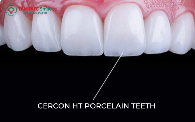 Cercon có cấu tạo 100% từ sứ nguyên khối, không gây đen viền nướu và hoàn toàn lành tính với cơ thể.