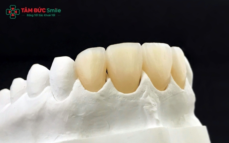 Trong khi Zirconia có độ trắng bền bỉ, Cercon (đặc biệt là Cercon HT) thường có độ trong mờ và vân răng tự nhiên hơn, giống hệt răng thật.