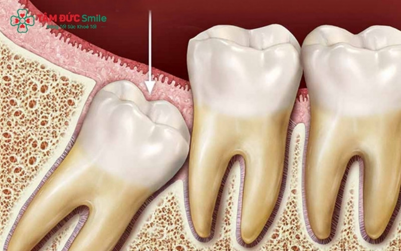 Răng khôn mọc thẳng có thể đóng vai trò như một răng hàm bổ trợ cho việc ăn nhai.