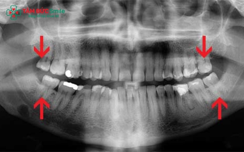 Răng khôn mọc thẳng và ăn khớp tốt với hàm đối diện là trường hợp lý tưởng để giữ lại.