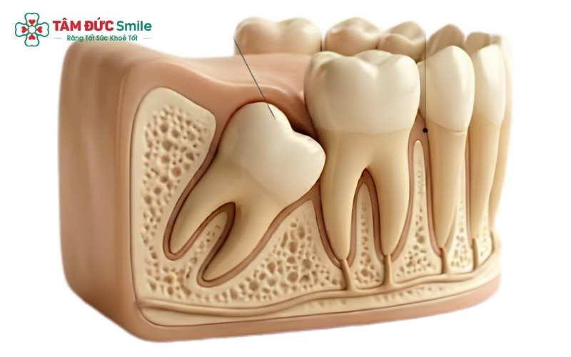 Răng khôn mọc lệch đe dọa trực tiếp đến sự an toàn của răng số 7 và cần được nhổ bỏ sớm.