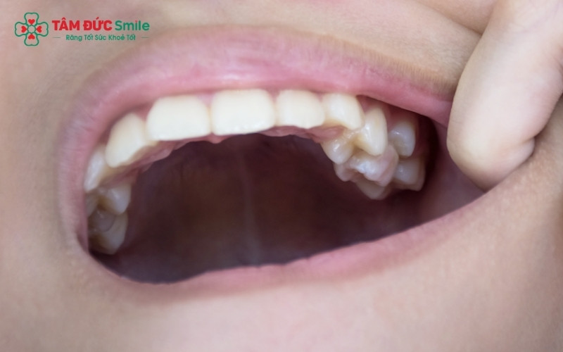 Sức nhai của hàm răng hoàn toàn không bị ảnh hưởng sau khi nhổ bỏ răng số 8.