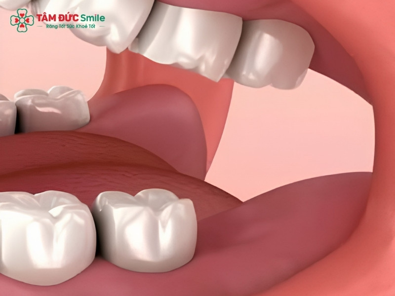 Tác dụng của răng khôn là gì? Nên giữ hay nhổ bỏ?