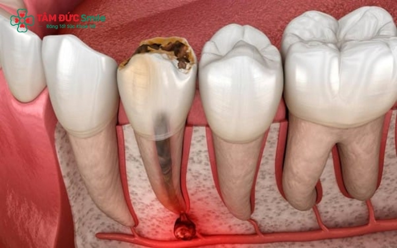 Sâu răng là một quá trình phá hủy âm thầm, nếu không can thiệp sớm sẽ dẫn đến viêm tủy và áp xe chân răng cực kỳ nguy hiểm.